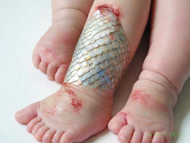 婴儿鱼鳞皮肤病怎么办,婴儿鱼鳞病是什么原因引起