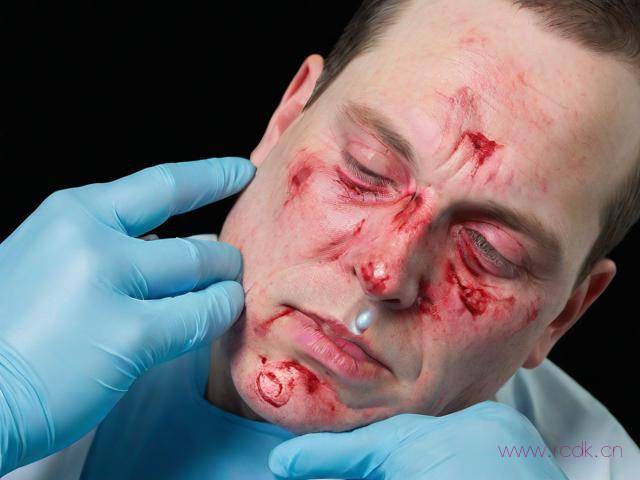 滴状银屑病怎么治疗,滴状银屑病怎么根治