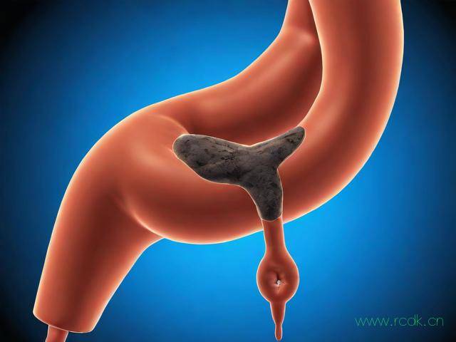 结肠黑变病轻度是怎么回事,结肠黑变病是什么病会癌变吗