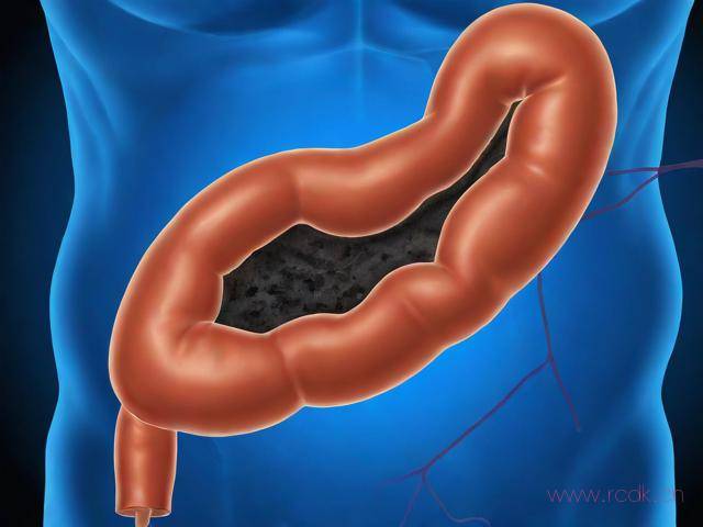 结肠黑变病轻度是怎么回事,结肠黑变病是什么病会癌变吗