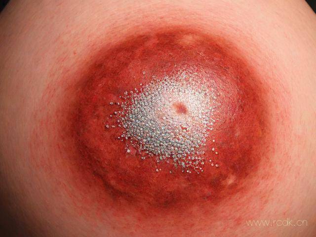 银屑病早期怎么发现,银屑病发现前期什么症状