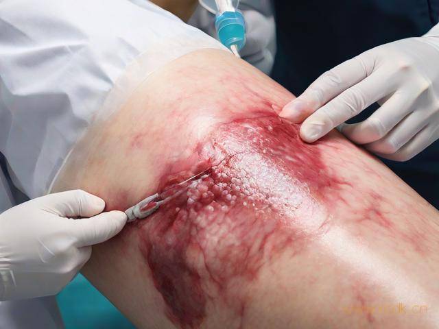 银宵皮肤病怎么诒,银霄病皮肤病的种类