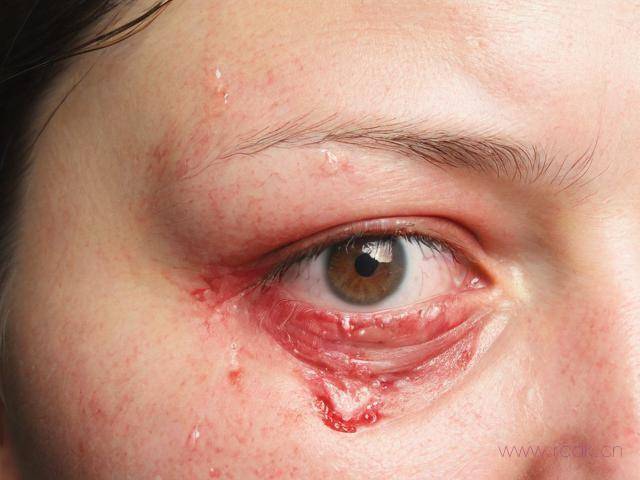 皮肤病湿疹怎么引起的,皮肤病湿疹是什么症状