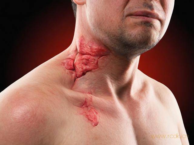 得了真菌皮肤病怎么办,真菌皮肤病能自愈吗